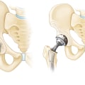 Understanding Joint Replacement Surgery