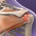 Understanding Rotator Cuff Injuries and How Physical Therapy Can Help