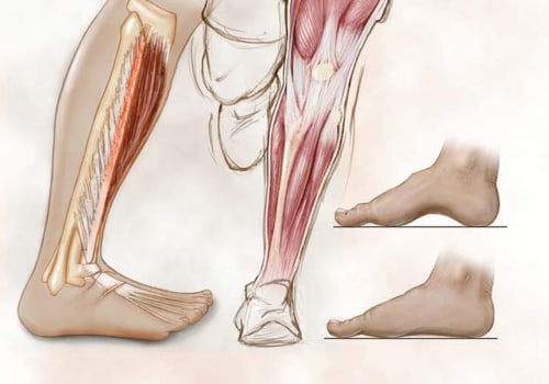 Understanding and Managing Shin Splints