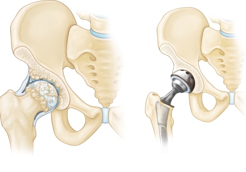 Understanding Joint Replacement Surgery