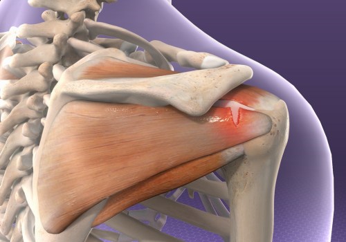 Understanding Rotator Cuff Injuries and How Physical Therapy Can Help